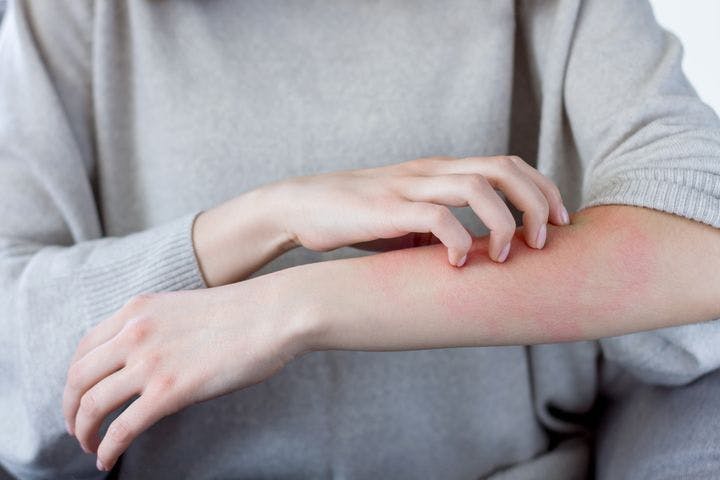 Keratosis Pilaris Vs Eczema Tell The Difference All Things Health