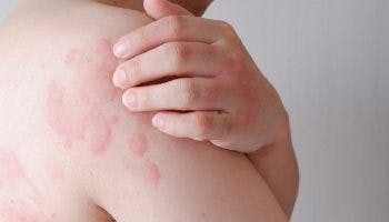 What causes hives 2 1