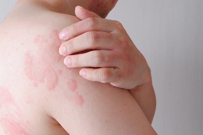 What causes hives 2 1