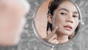 Woman with melasma examines her face in the mirror