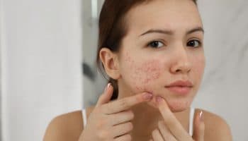 Woman touches her chin with hormonal acne lesions.