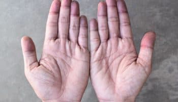 Discoloured fingertips are a notable sign of Raynaud’s phenomenon.