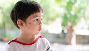 Little boy with varicella zoster or chickenpox rashes all over face and neck