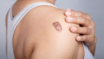 Side-view of a woman's upper body with her left hand placed near a keloid scar on the right shoulder.