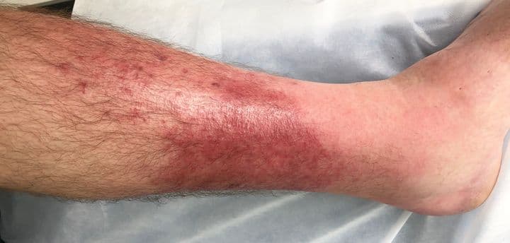 A man‘s leg suffering from cellulitis.