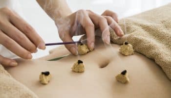 Woman lighting up mugwort leaf fluffs that are placed on specific points on another woman’s abdomen.