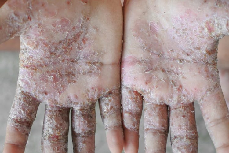 Scabies: A Very Itchy But Curable Rash 