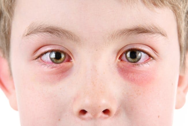 Pink eye in children