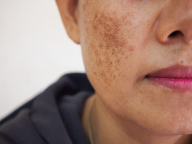 Melasma min scaled