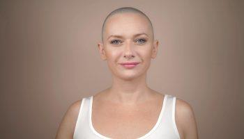 Alopecia min scaled